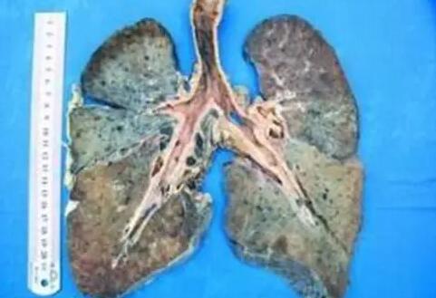 烟尘肺病——焊接91好色先生TV在线下载